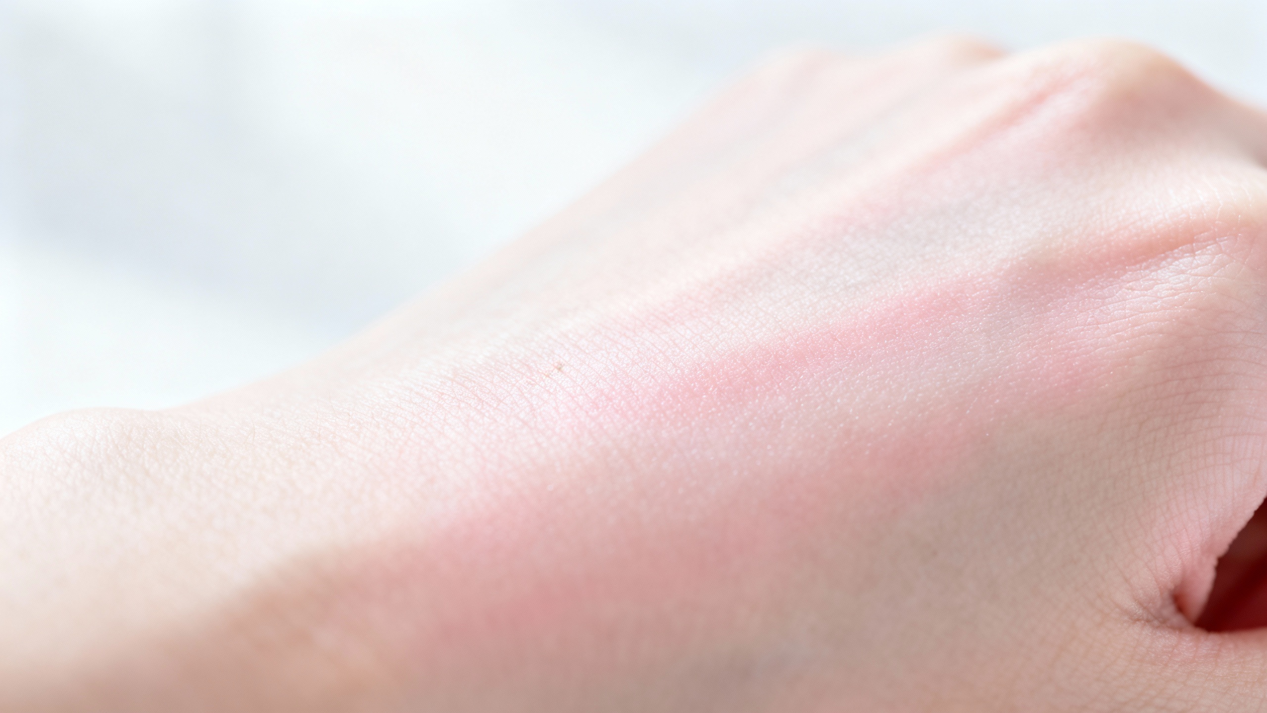 Featured image for 4. Say Goodbye to Discomfort: Effective Relief for Ringworm